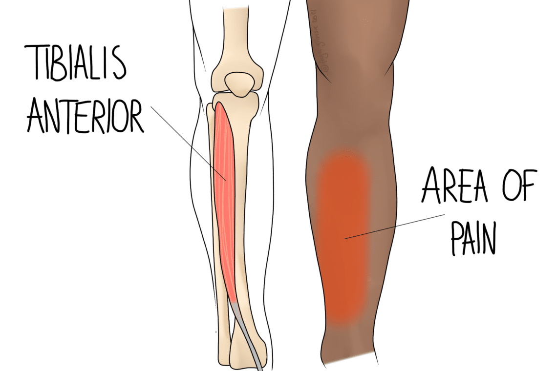 Diagram depicting a leg; left shows "Tibialis Anterior" muscle in red, right highlights "Area of Pain" on a section of a human leg with brown skin.