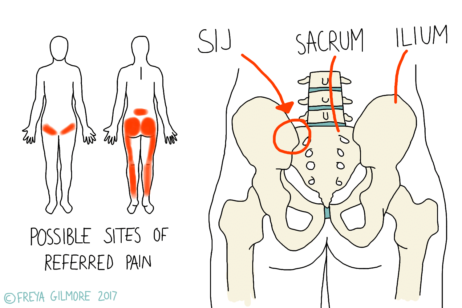 Illustration showing areas of referred pain on a human figure's lower back, hips, and legs, alongside a diagram of the pelvis labeled "SIJ," "Sacrum," "Ilium." Text: "Possible sites of referred pain."