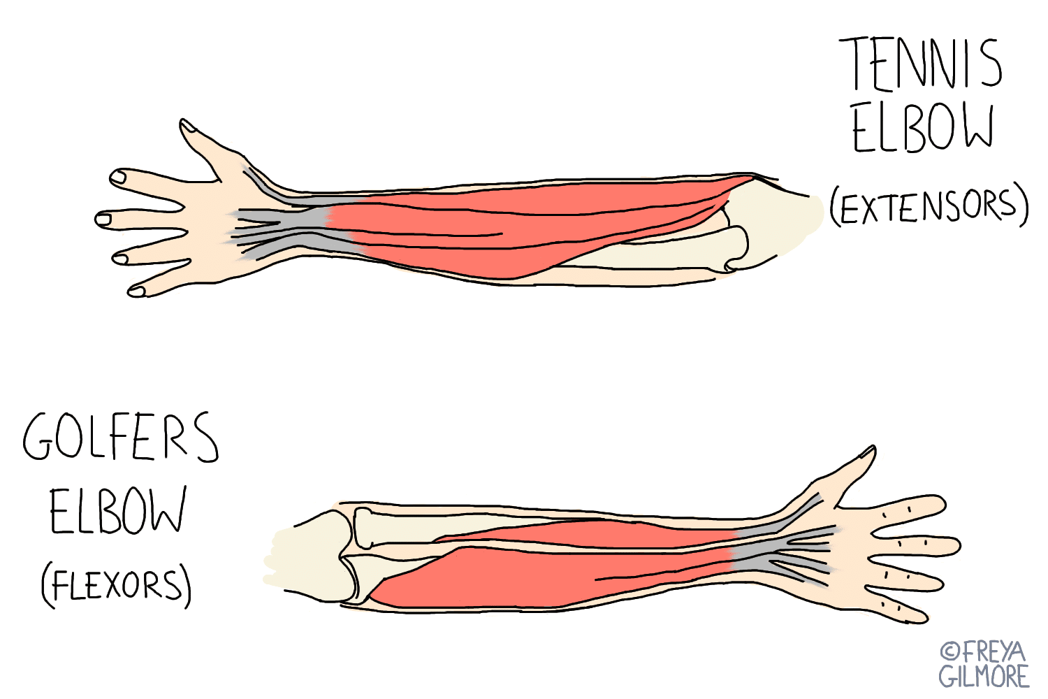 Two labeled illustrations of forearms: 1. Top arm shows "Tennis Elbow (Extensors)" with muscles highlighted. 2. Bottom arm shows "Golfers Elbow (Flexors)" with muscles highlighted. Text: ©FREYA GILMORE.