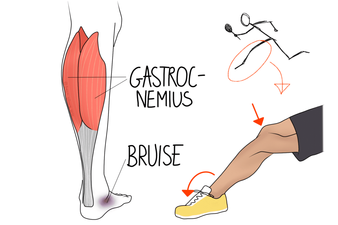 Gastrocnemius muscle diagram highlights a bruise, with an illustrated tennis player lunging, emphasizing calf strain. A flexed leg with a yellow shoe shows potential injury. Text: “GASTROCNEMIUS” and “BRUISE.”