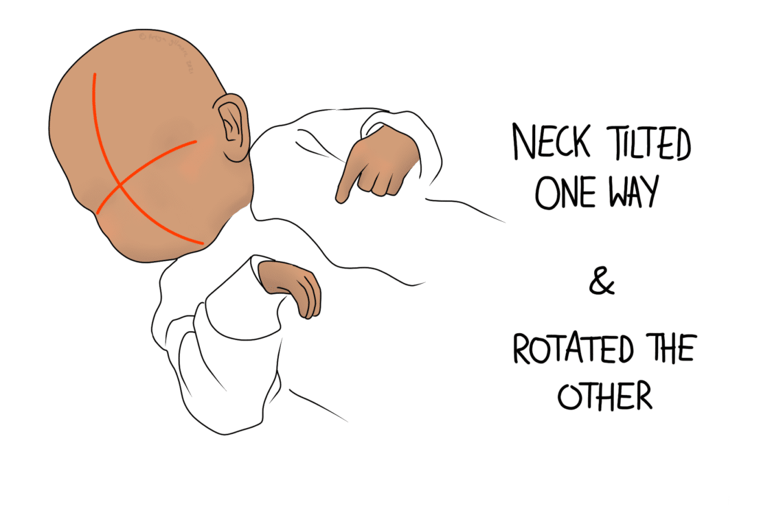 A bald baby with an orange line X on the head lies sideways, wearing a white garment. Text reads: "Neck tilted one way & rotated the other."