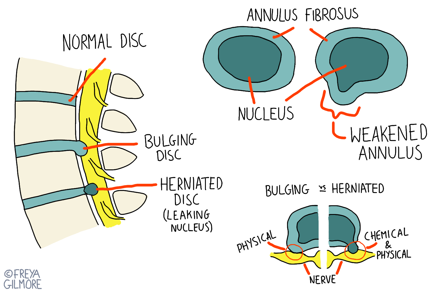 Degenerative Disc Disease