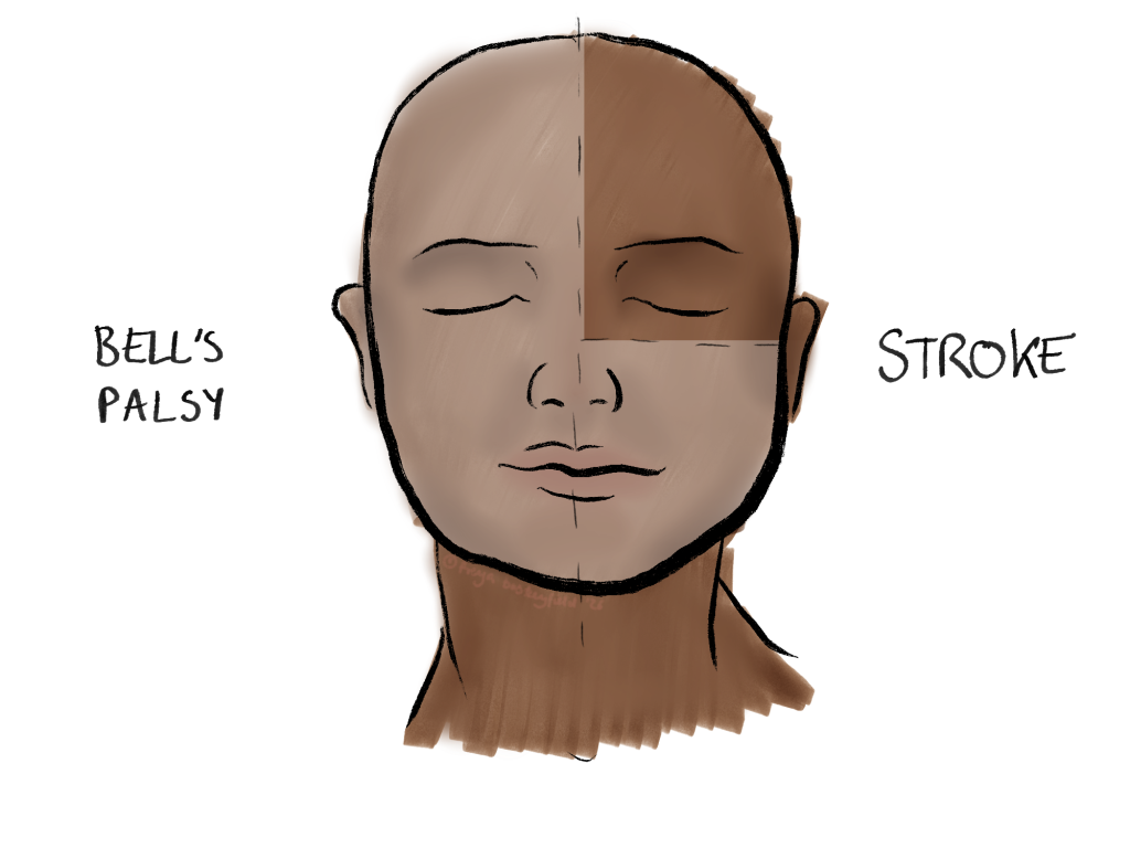 Bells palsy vs stroke