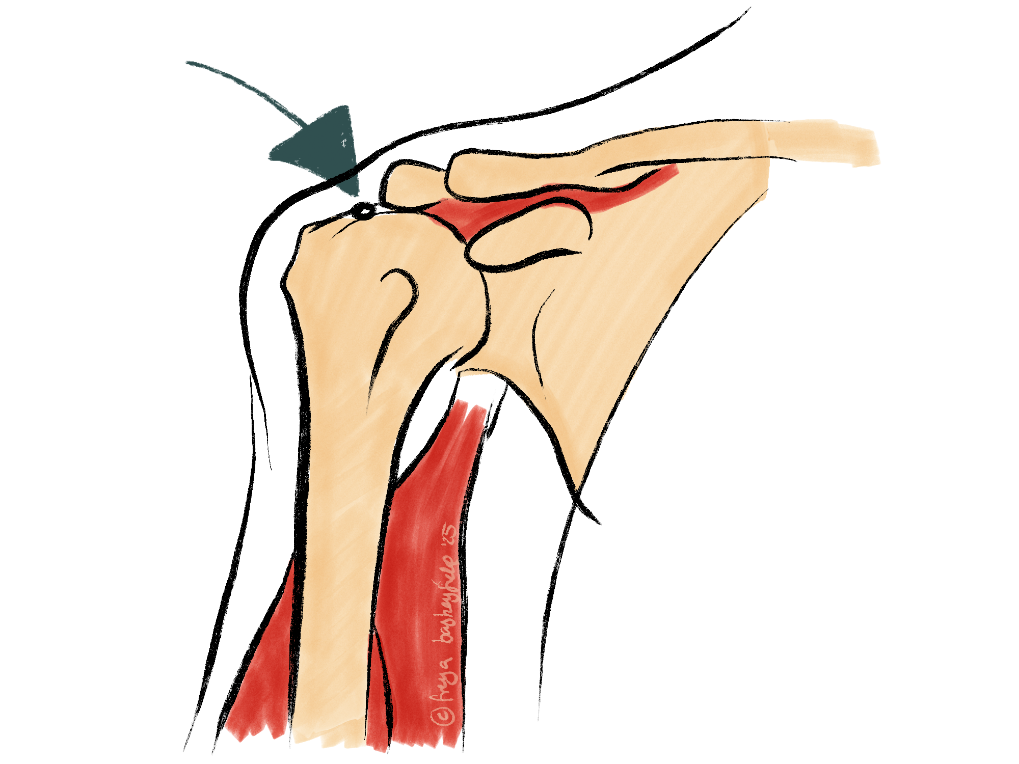 Calcific tendinopathy