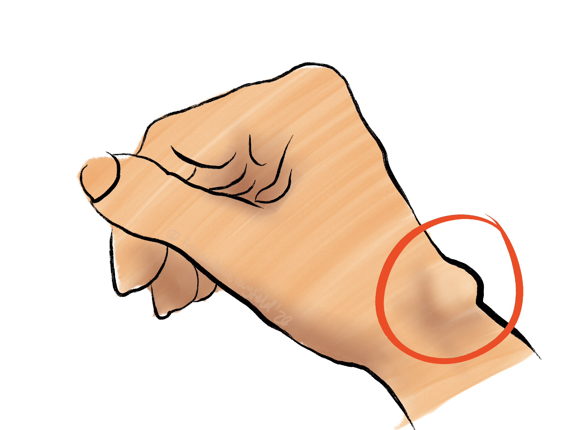 Ganglion cyst