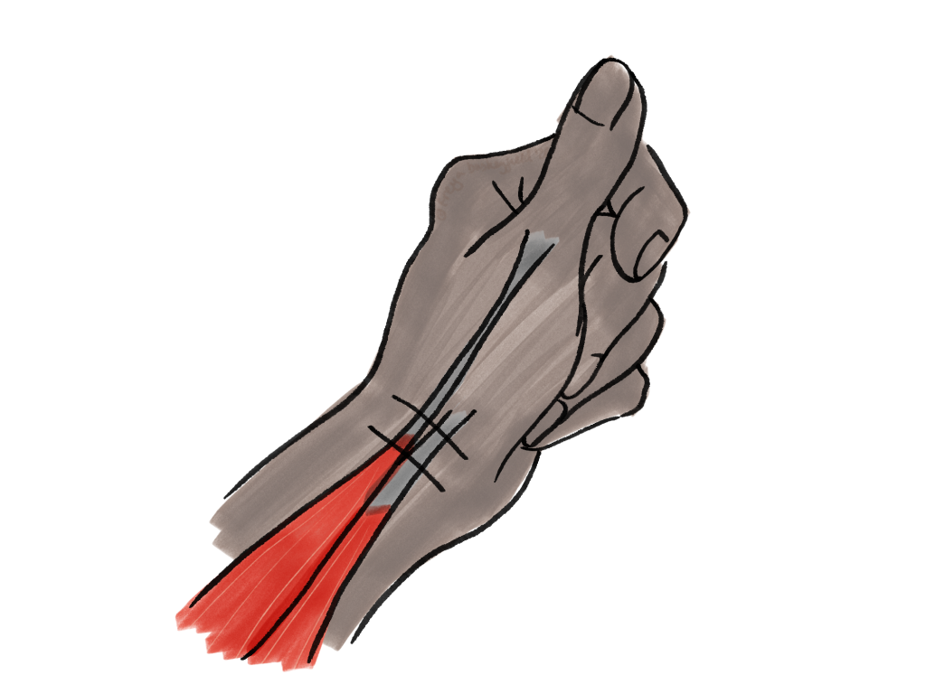 De Quervain's Tenosynovitis